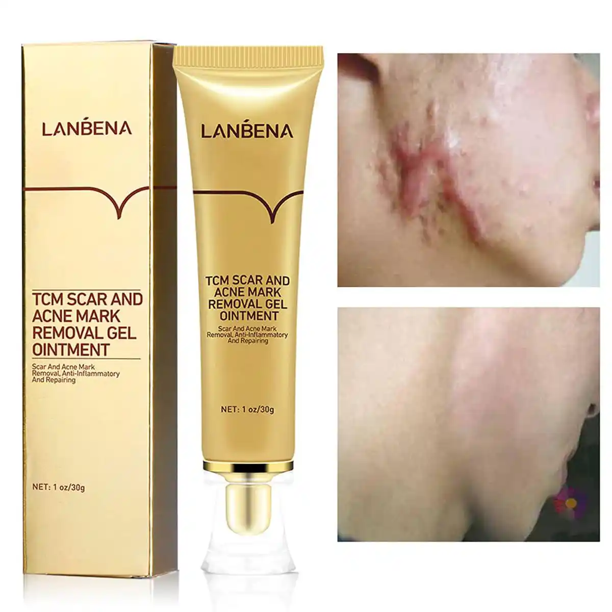 Lanbena TCM Scar And Acne Mark Removal Cream